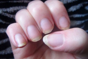 brittle_nails